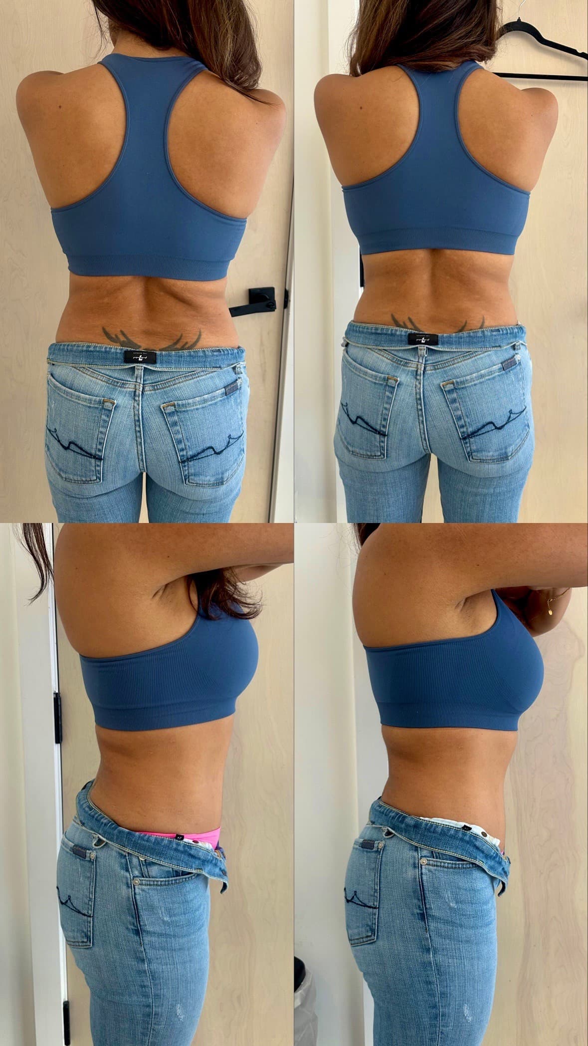 Body contouring results - left: after 1 year of treatments, right: after a 30-minute touch-up